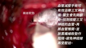 有關微血管減壓手術的圖片
