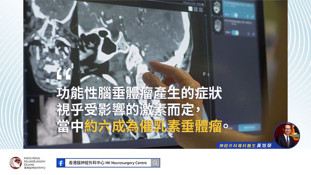 黃旭榮醫生解釋功能性腦垂體瘤產生的症狀