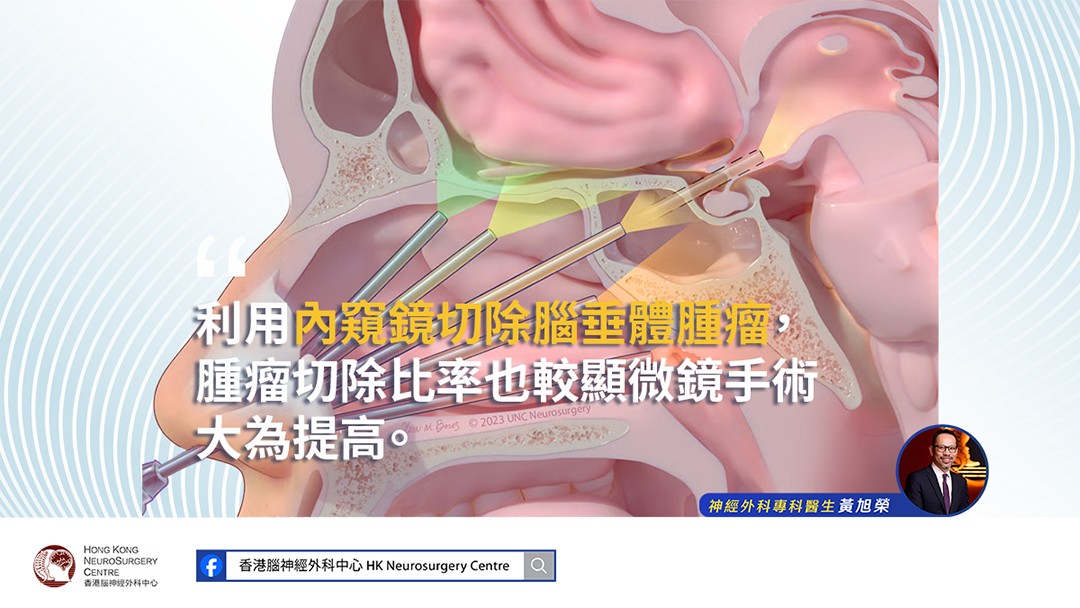 黃旭榮醫生解釋了切除非功能性腦下垂體腫瘤的微創選項