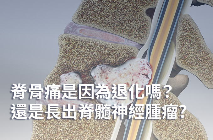 脊髓神經腫瘤引起腰痛