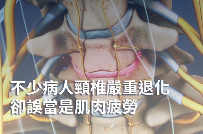 頸椎退化 | 低頭族手痹肩痛齊來 頸椎退化咪當瞓捩頸