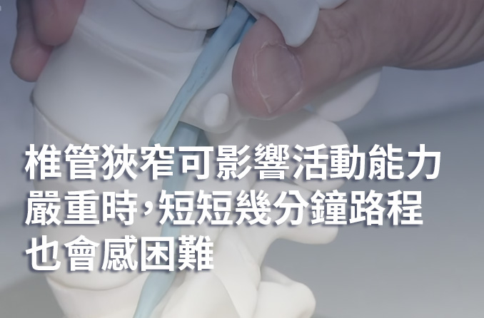 椎管狹窄 | 椎骨退化令你跛行