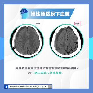 慢性硬腦膜下血腫電腦掃描圖片