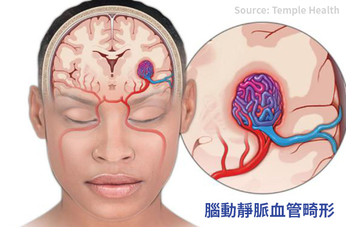 腦動靜脈血管畸形 | 少年撞邪記(下)