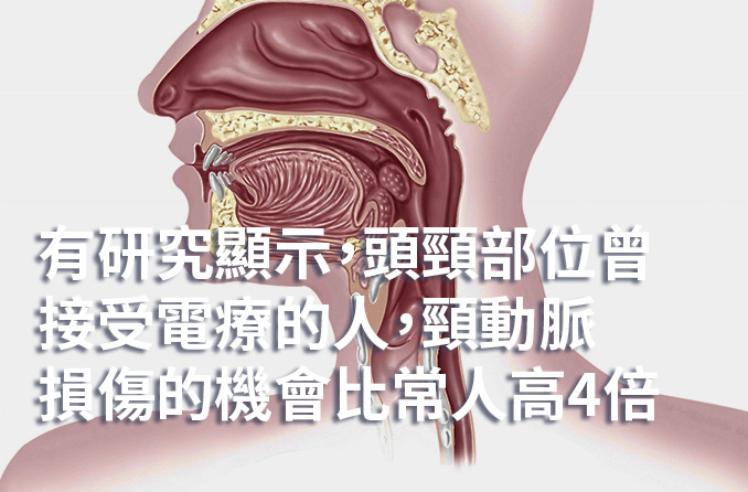 頸動脈狹窄，誰之過？